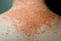 Biến chứng ghẻ có thể viêm cầu thận