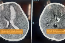 Cứu sống 3 bệnh nhi bị xuất huyết não do vỡ dị dạng mạch máu