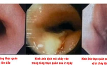 Hy hữu: Đau ngực do xương cá xuyên từ lòng thực quản tạo ổ áp xe