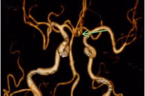 Cứu người bệnh chảy máu dưới nhện do phình mạch máu não