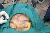 Phồng trán không ngờ u nhầy xoang trán hiếm gặp