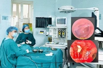 Lần đầu phẫu thuật tạo hình xương con tai giữa tại BV Nhi Thanh Hoá