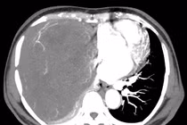 U nhỏ không điều trị để nặng 2kg choán hết lồng ngực, đè xẹp phổi....