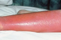 Vi khuẩn thường trực trên da gây viêm mô tế bào nguy kịch khi trầy xước