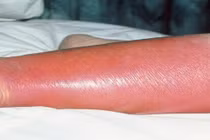 Vi khuẩn thường trực trên da gây viêm mô tế bào nguy kịch khi trầy xước