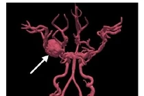 18 tuổi bị đột quỵ hiếm gặp chưa có trong y văn