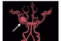 18 tuổi bị đột quỵ hiếm gặp chưa có trong y văn