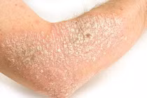 Cách phòng tránh khởi phát và tăng nặng bệnh vẩy nến