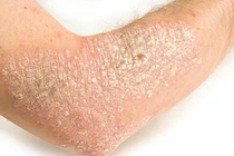 Cách phòng tránh khởi phát và tăng nặng bệnh vẩy nến