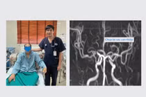 Can thiệp mạch lấy huyết khối, giải pháp tối ưu trong trị nhồi máu não cấp