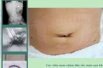 2,5 giờ nội soi lấy 10 cục nam châm khiến bé trai 18 tuổi thủng ruột
