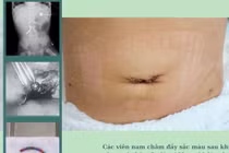 2,5 giờ nội soi lấy 10 cục nam châm khiến bé trai 18 tuổi thủng ruột