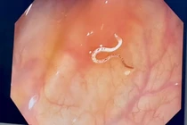 Phát hiện giun còn sống trong đại tràng của người đàn ông