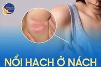 Nổi hạch ở nách khi nào cần đi khám?
