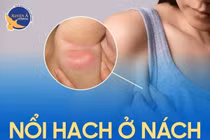 Nổi hạch ở nách khi nào cần đi khám?