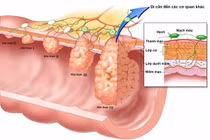Viêm ruột mạn tính, tái phát thường xuyên do bệnh Crohn ít người biết