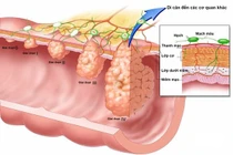 Viêm ruột mạn tính, tái phát thường xuyên do bệnh Crohn ít người biết