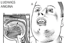 Tự chữa đau răng người đàn ông suýt tử vong vì viêm tấy sàn miệng 