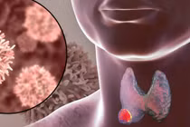 Chế độ ăn ăn kiêng cho bệnh nhân uống I - ốt phóng xạ