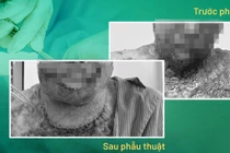 Vừa đốt cỏ làm rẫy vừa hút thuốc lá nam thanh niên bỏng 75% cơ thể