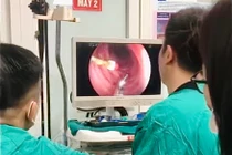 Nội soi lấy kim diệt tủy răng rơi vào tá tràng bé trai 8 tuổi