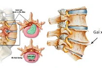 Có nên cắt bỏ gai cột sống?