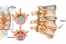 Có nên cắt bỏ gai cột sống?