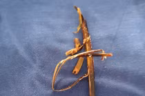 Lấy cành cây khô 10cm trong bàng quang bệnh nhân