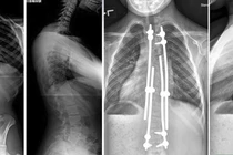 Vẹo cột sống khởi phát sớm có thể gây tử vong: Phát hiện cách nào?