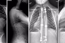 Vẹo cột sống khởi phát sớm có thể gây tử vong: Phát hiện cách nào?