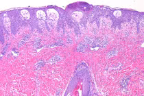 Phát ban mụn mủ toàn thân cấp tính do dùng thuốc