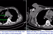Khối u vỡ loét chảy dịch do điều trị ung thư vú bằng đắp thuốc nam
