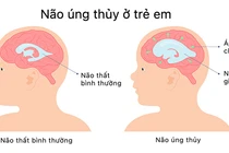 Hầu hết các trường hợp não úng thủy có thể điều trị?