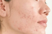 Sạm da, nổi mụn vì dùng Retinoids sai cách