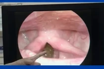 Khàn tiếng, vướng cổ không ngờ đỉa dài 6 cm sống trong cổ họng 1 tháng