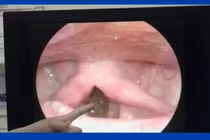 Khàn tiếng, vướng cổ không ngờ đỉa dài 6 cm sống trong cổ họng 1 tháng