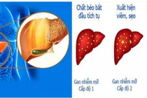 Cách giảm cả mỡ máu và gan nhiễm mỡ cùng 1 lúc