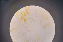 Cụ ông nguy kịch vì giun lươn lan tỏa kèm bệnh lý nền