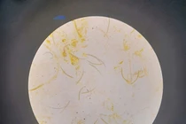 Giun lươn: bệnh truyền nhiễm nguy hiểm nhiều người mắc nhưng bị lãng quên