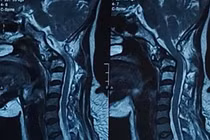 Bệnh nhân ung thư phổi di căn đốt sống cổ cao 