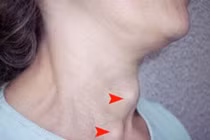 Tuyến giáp - sát thủ thầm lặng có thể hủy hoại trái tim