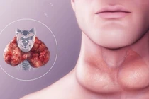 Bướu giáp đơn thuần có nguy hiểm không?