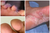 Chăm sóc, phòng tránh bệnh da và nguy cơ bỏng đúng cách mùa bão lũ