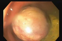 Hy hữu: Bé 37 tháng tuổi có polyp lớn trực tràng sa ra ngoài, chảy máu