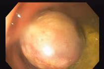 Hy hữu: Bé 37 tháng tuổi có polyp lớn trực tràng sa ra ngoài, chảy máu