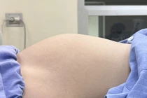 Thiếu nữ 17 tuổi mang u buồng trứng như thai 7 tháng