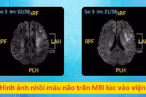 Đột nhiên yếu nửa người, mất ngôn ngữ sau khi thức giấc... do nhồi máu não