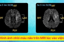 Đột nhiên yếu nửa người, mất ngôn ngữ sau khi thức giấc... do nhồi máu não