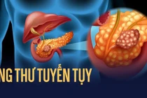 Cách phát hiện sớm ung thư tụy sâu trong ổ bụng, ác tính, tử vong cao