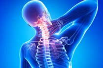  Thực phẩm chức năng hỗ trợ điều trị thoái hóa đốt sống cổ